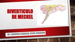 DIVERTICULO
DE MECKEL
 