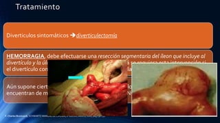 Tratamiento
Diverticulos sintomáticos diverticulectomía
HEMORRAGIA, debe efectuarse una resección segmentaria del íleon que incluye al
divertículo y la úlcera péptica ileal adyacente. Quizá se requiera esta intervención si
el divertículo contiene un tumor o su base está inflamada o perforada.
Aún supone cierta controversia el tratamiento de los divertículos de Meckel que se
encuentran de modo incidental (asintomáticos). NO SE RECOMIENDA
F. Charles Brunicardi, SCHWARTZ MANUAL DE CIRUGÍA, 8ª edición, México, 2007, pag 730-731
 