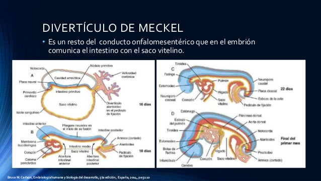 Diverticulo de meckel