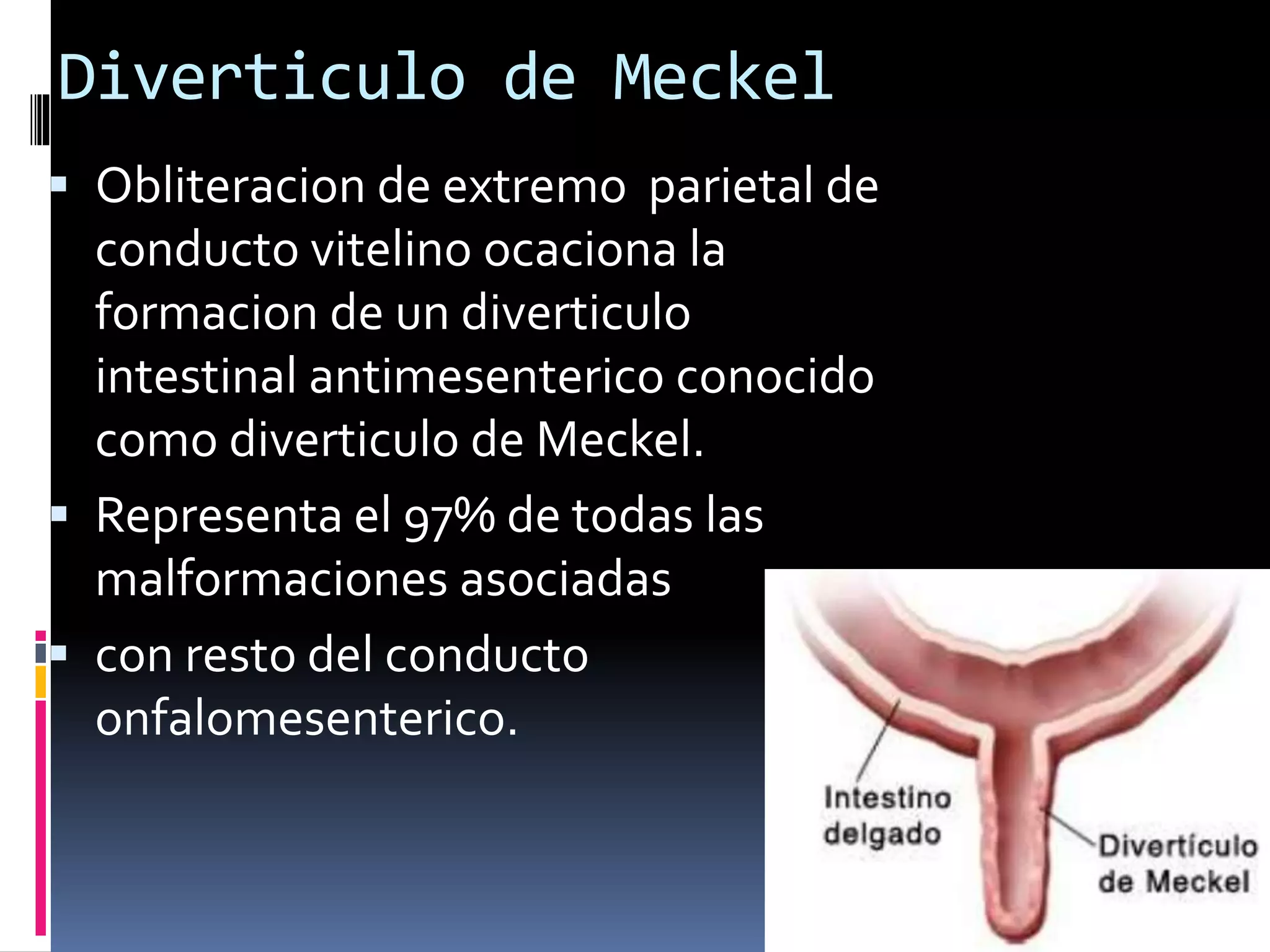 Diverticulo de meckel PPT
