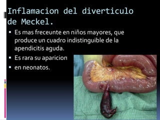 Inflamacion del diverticulo
de Meckel.
 Es mas freceunte en niños mayores, que
produce un cuadro indistinguible de la
apendicitis aguda.
 Es rara su aparicion
 en neonatos.
 