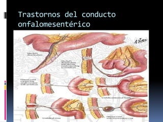 Trastornos del conducto
onfalomesentérico
 