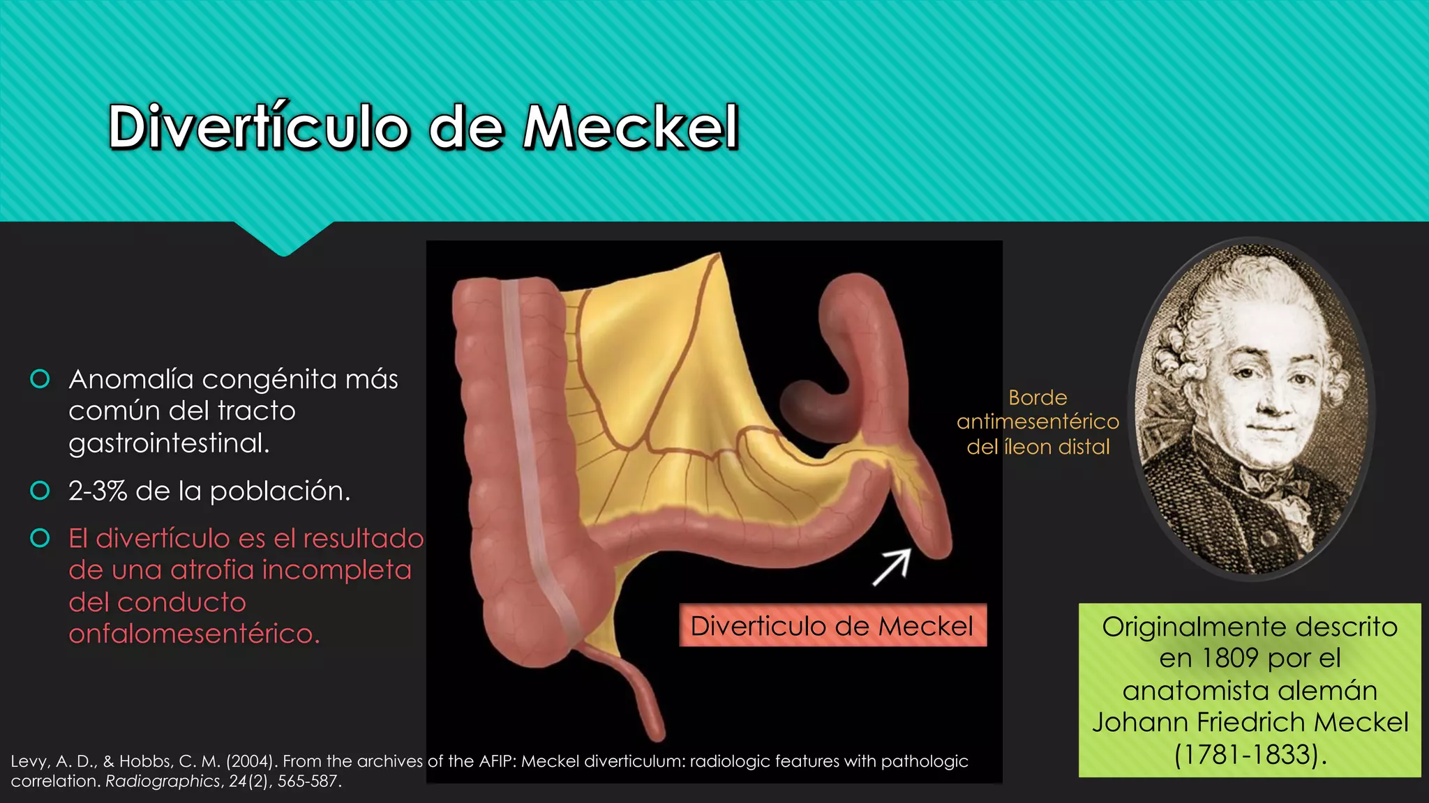 DIVERTICULO DE MECKEL.pdf