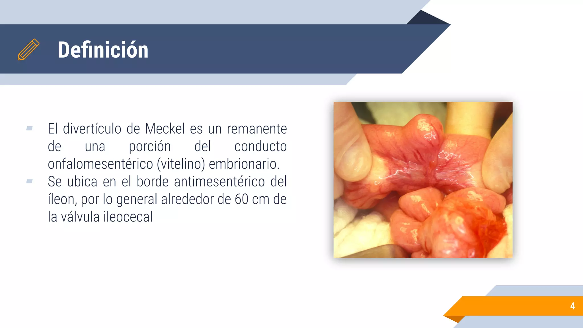 Divertículo de Meckel