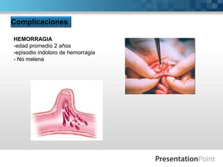 Complicaciones
HEMORRAGIA
-edad promedio 2 años
-episodio indoloro de hemorragia
- No melena

 