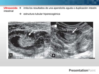 Ultrasonido  imita los resultados de una apendicitis aguda o duplicación intestin
intestinal
 estructura tubular hiperecogénica

 