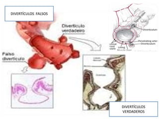 DIVERTÍCULOS FALSOS

DIVERTÍCULOS
VERDADEROS

 