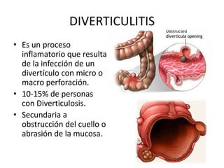 DIVERTICULITIS
• Es un proceso
inflamatorio que resulta
de la infección de un
divertículo con micro o
macro perforación.
• 10-15% de personas
con Diverticulosis.
• Secundaria a
obstrucción del cuello o
abrasión de la mucosa.

 