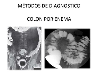 MÉTODOS DE DIAGNOSTICO
COLON POR ENEMA

 