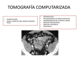 TOMOGRAFÍA COMPUTARIZADA
•
•

DIVERTICULOSIS
SACOS LLENOS DE AIRE, BARIO O MATERIA
FECAL

•
•
•
•
•
•

DIVERTICULITIS
INFLAMACIÓN DE LA GRASA PERICOLICA
ENGROSAMIENTO DE LA PARED (>4MM)
ABSCESO PERICOLONICO
ABSCESO A DISTANCIA
PERITONITIS

 