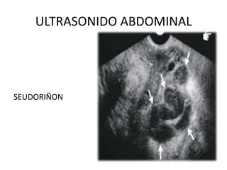 ULTRASONIDO ABDOMINAL

SEUDORIÑON

 