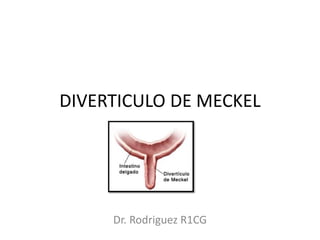 DIVERTICULO DE MECKEL
Dr. Rodriguez R1CG
 