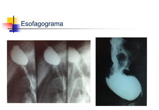 Esofagograma
 