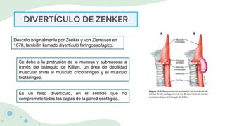 DIVERTÍCULO DE ZENKER
Descrito originalmente por Zenker y von Ziemssen en
1878, también llamado divertículo faringoesofágico.
Se debe a la protrusión de la mucosa y submucosa a
través del triángulo de Killian, un área de debilidad
muscular entre el musculo cricofaringeo y el musculo
tirofaríngeo.
Es un falso divertículo, en el sentido que no
compromete todas las capas de la pared esofágica.
 