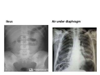 ileus Air under diaphragm
 
