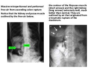 Massive retroperitoneal and peritoneal
free-air from ascending colon rupture
Notice that the kidney and psoas muscle
outlined by the free-air below.
the contour of the iliopsoas muscle
(short arrows) and the right kidney
(long arrows) extremely well, much
better than normal. They are
outlined by air that originated from
a traumatic rupture of the
duodenum.
 