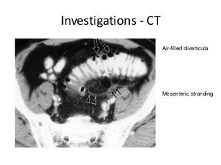 Investigations - CT
Air-filled diverticula
Mesenteric stranding
 