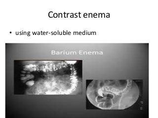 Contrast enema
• using water-soluble medium
 
