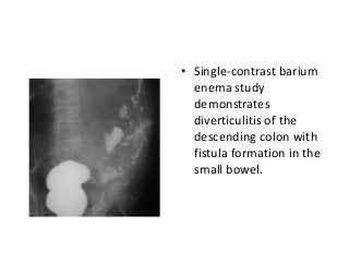 • Single-contrast barium
enema study
demonstrates
diverticulitis of the
descending colon with
fistula formation in the
small bowel.
 