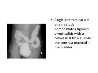 • Single-contrast barium
enema study
demonstrates sigmoid
diverticulitis with a
colovesical fistula. Note
the contrast material in
the bladder.
 