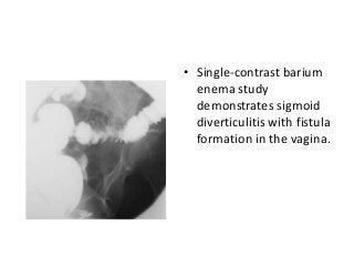 • Single-contrast barium
enema study
demonstrates sigmoid
diverticulitis with fistula
formation in the vagina.
 