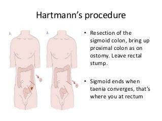 Hartmann’s procedure
• Resection of the
sigmoid colon, bring up
proximal colon as on
ostomy. Leave rectal
stump.
• Sigmoid ends when
taenia converges, that’s
where you at rectum
 