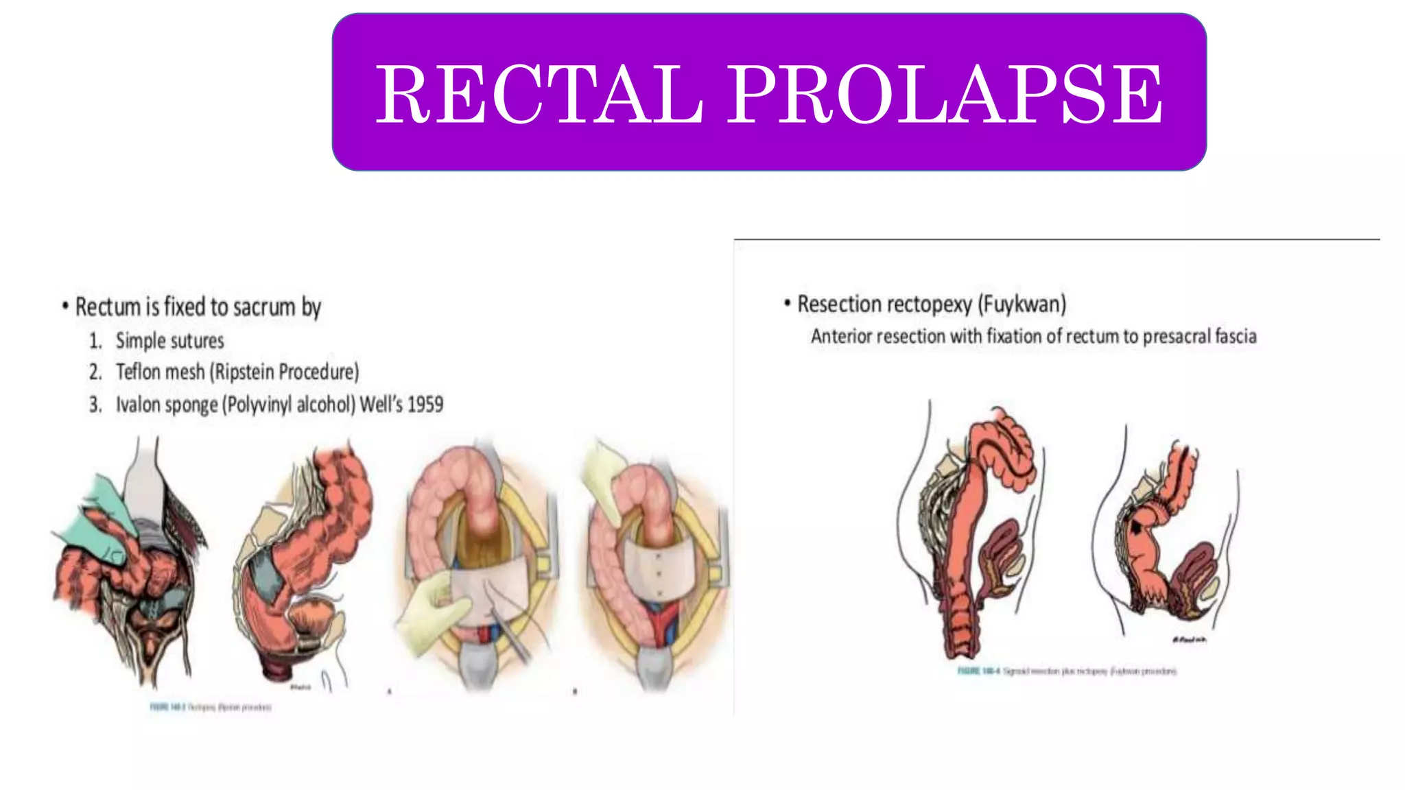 Diverticulosis Volvulus Rectal Prolapse PPT
