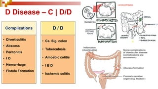D Disease – C | D/D
Complications
• Diverticulitis
• Abscess
• Peritonitis
• I O
• Hemorrhage
• Fistula Formation
D / D
• Ca. Sig. colon
• Tuberculosis
• Amoebic colitis
• I B D
• Ischemic colitis
 