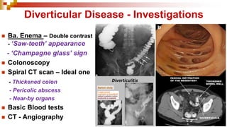 ◼ Ba. Enema – Double contrast
- ‘Saw-teeth’ appearance
- ‘Champagne glass’ sign
◼ Colonoscopy
◼ Spiral CT scan – Ideal one
- Thickened colon
- Pericolic abscess
- Near-by organs
◼ Basic Blood tests
◼ CT - Angiography
Diverticular Disease - Investigations
 