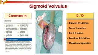 Sigmoid Volvulus
Common in D / D
• Ogilvie's Syndrome.
• Faecal Impaction.
• Ca. R S region.
• Ileo-sigmoid knotting.
• Idiopathic megacolon.
 