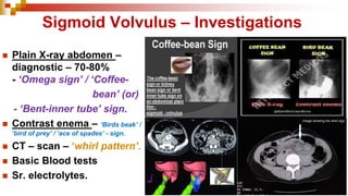 Sigmoid Volvulus – Investigations
◼ Plain X-ray abdomen –
diagnostic – 70-80%
- ‘Omega sign’ / ‘Coffee-
bean’ (or)
- ‘Bent-inner tube’ sign.
◼ Contrast enema – ‘Birds beak’ /
‘bird of prey’ / ‘ace of spades’ - sign.
◼ CT – scan – ‘whirl pattern’.
◼ Basic Blood tests
◼ Sr. electrolytes.
 