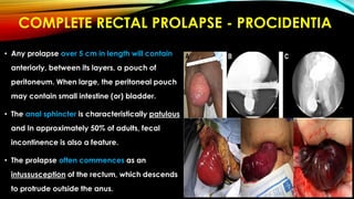 COMPLETE RECTAL PROLAPSE - PROCIDENTIA
• Any prolapse over 5 cm in length will contain
anteriorly, between its layers, a pouch of
peritoneum. When large, the peritoneal pouch
may contain small intestine (or) bladder.
• The anal sphincter is characteristically patulous
and In approximately 50% of adults, fecal
incontinence is also a feature.
• The prolapse often commences as an
intussusception of the rectum, which descends
to protrude outside the anus.
 