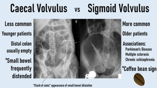 Diverticulosis, Volvulus & Rectal prolapse.pdf