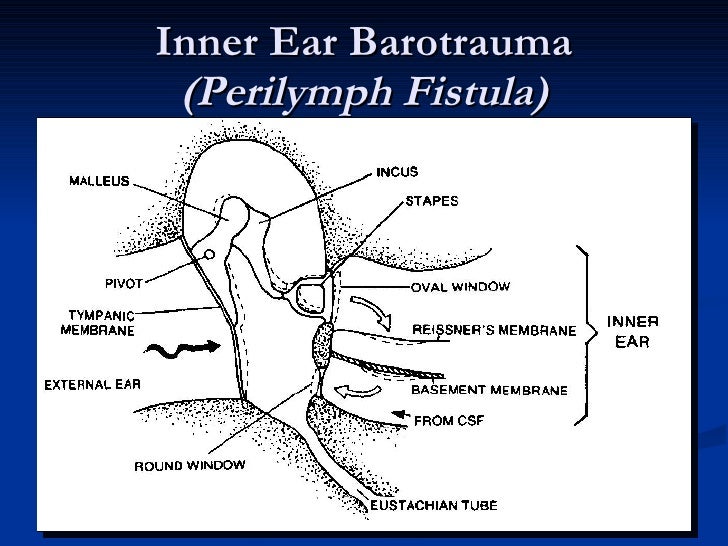 inner ear barotrauma treatment
