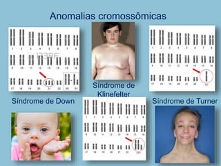 Anomalias cromossômicas
Síndrome de Down Síndrome de Turner
Síndrome de
Klinefelter
 
