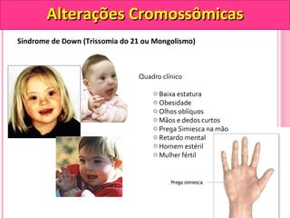 AAlltteerraaççõõeess CCrroommoossssôômmiiccaass 
Síndrome de Down (Trissomia do 21 ou Mongolismo) 
Quadro clínico 
o Baixa estatura 
o Obesidade 
o Olhos oblíquos 
o Mãos e dedos curtos 
o Prega Simiesca na mão 
o Retardo mental 
o Homem estéril 
o Mulher fértil 
 