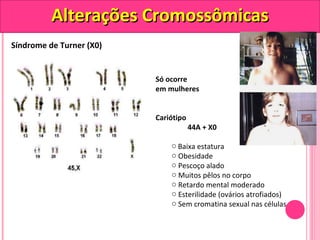 AAlltteerraaççõõeess CCrroommoossssôômmiiccaass 
Síndrome de Turner (X0) 
Só ocorre 
em mulheres 
Cariótipo 
44A + X0 
o Baixa estatura 
o Obesidade 
o Pescoço alado 
o Muitos pêlos no corpo 
o Retardo mental moderado 
o Esterilidade (ovários atrofiados) 
o Sem cromatina sexual nas células 
 