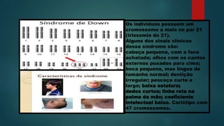 Os indivíduos possuem um
cromossomo a mais no par 21
(trissomia do 21).
Alguns dos sinais clínicos
dessa síndrome são:
cabeça pequena, com a face
achatada; olhos com os cantos
externos puxados para cima;
boca pequena, mas língua de
tamanho normal; dentição
irregular; pescoço curto e
largo; baixa estatura;
dedos curtos; linha reta na
palma da mão; coeficiente
intelectual baixo. Cariótipo com
47 cromossomos.
 