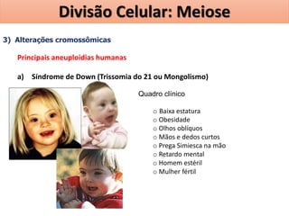 3) Alterações cromossômicas
Principais aneuploidias humanas
a) Síndrome de Down (Trissomia do 21 ou Mongolismo)
Quadro clínico
o Baixa estatura
o Obesidade
o Olhos oblíquos
o Mãos e dedos curtos
o Prega Simiesca na mão
o Retardo mental
o Homem estéril
o Mulher fértil
Divisão Celular: Meiose
 