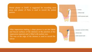 Dental plaster or ZnOE is suggested for recording most
areas and plaster of Paris is used to record the palatal
portion.
After impression making, a deep groove is cut into labial
and buccal surfaces of the dentures at the junction of the
impression material and is filled with molten wax.
The wax at the edge of the denture is used to record the
sulcus
 