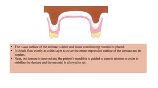 • The tissue surface of the denture is dried and tissue conditioning material is placed.
• It should flow evenly as a thin layer to cover the entire impression surface of the denture and its
borders.
• Next, the denture is inserted and the patient's mandible is guided to centric relation in order to
stabilize the denture and the material is allowed to set.
 