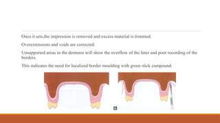 Once it sets,the impression is removed and excess material is trimmed.
Overextensions and voids are corrected.
Unsupported areas in the dentures will show the overflow of the liner and poor recording of the
borders.
This indicates the need for localized border moulding with green stick compound.
 