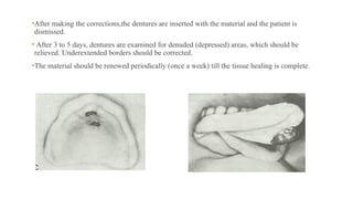 •After making the corrections,the dentures are inserted with the material and the patient is
dismissed.
• After 3 to 5 days, dentures are examined for denuded (depressed) areas, which should be
relieved. Underextended borders should be corrected.
•The material should be renewed periodically (once a week) till the tissue healing is complete.
 