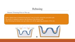 Rebasing
Denture Trimming Prior to Wax-up
Entire denture base is trimmed leaving just 2 mm of acrylic around the porcelain teeth.
The acrylic is retained to preserve the positions of the denture teeth.
After trimming the denture wax up is done over all the supporting structures of the cast.
 