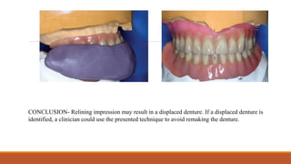 CONCLUSION- Relining impression may result in a displaced denture. If a displaced denture is
identified, a clinician could use the presented technique to avoid remaking the denture.
 