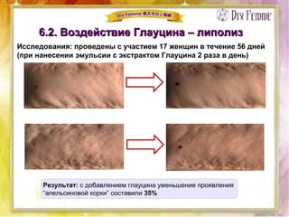 6.2. Воздействие Глауцина – липолиз6.2. Воздействие Глауцина – липолиз
Исследования: проведены с участием 17 женщин в течение 56 дней
(при нанесении эмульсии с экстрактом Глауцина 2 раза в день)
Результат: с добавлением глауцина уменьшение проявления
“апельсиновой корки” составили 35%
 