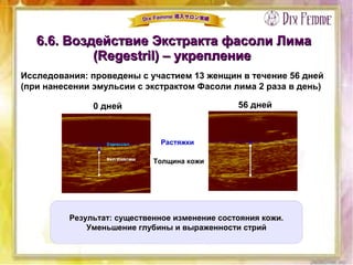 6.6. Воздействие Экстракта фасоли Лима6.6. Воздействие Экстракта фасоли Лима
(Regestril) – укрепление(Regestril) – укрепление
Результат: существенное изменение состояния кожи.
Уменьшение глубины и выраженности стрий
Растяжки
Толщина кожи
0 дней 56 дней
Исследования: проведены с участием 13 женщин в течение 56 дней
(при нанесении эмульсии с экстрактом Фасоли лима 2 раза в день)
 