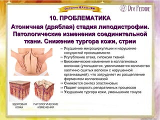 10. ПРОБЛЕМАТИКА10. ПРОБЛЕМАТИКА
Атоничная (дряблая) стадия липодистрофии.Атоничная (дряблая) стадия липодистрофии.
Патологические изменения соединительнойПатологические изменения соединительной
ткани. Снижение тургора кожи, стрииткани. Снижение тургора кожи, стрии
⇒ Ухудшение микроциркуляции и нарушение
сосудистой проницаемости
⇒ Усугубление отека, гипоксия тканей
⇒ Биохимические изменения в коллагеновых
волокнах (утолщаются, увеличивается количество
хаотично сшитых волокон с нарушенной
организацией), что затрудняет их расщепление
ферментом коллагеназой
⇒ Снижается синтез эластиновых
⇒ Падает скорость репаративных процессов
⇒ Ухудшение тургора кожи, уменьшение тонуса
ЗДОРОВАЯ
КОЖА
ПАТОЛОГИЧЕСКИЕ
ИЗМЕНЕНИЯ
 