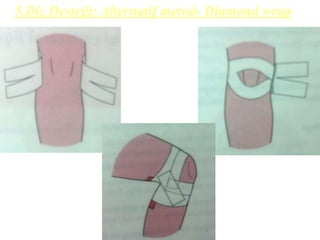 5.Diz Desteği: Alternatif metod- Diamond wrap 
 