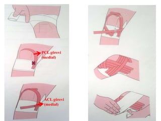 PCL görevi 
(medial) 
ACL görevi 
(medial) 
 